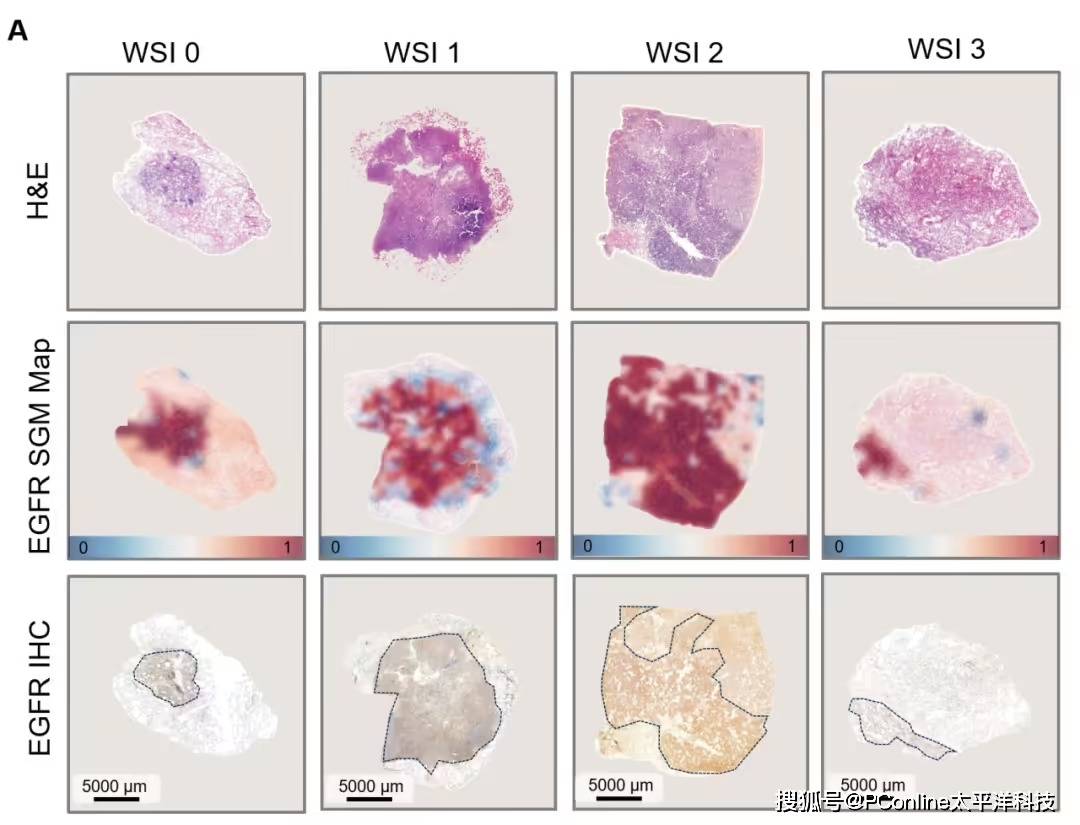 准确率高达 99%!腾讯 AI 可预测肺癌基因突变